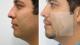 corecciones-faciales-sin-cirugia-Ciudad-de-Panam-Rinoplastia