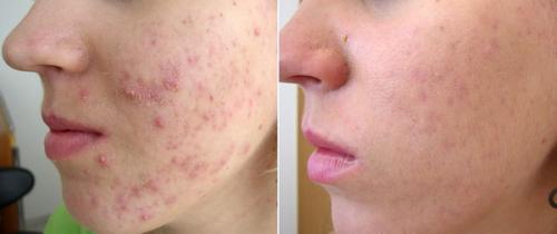 efectiva eliminación del acne El ms efecti - Imagen 1