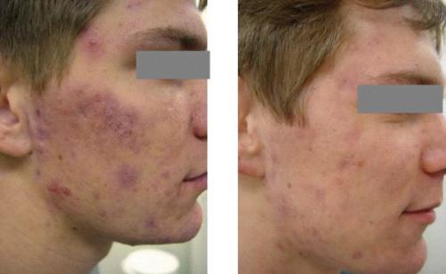 efectiva eliminación del acne El ms efecti - Imagen 2