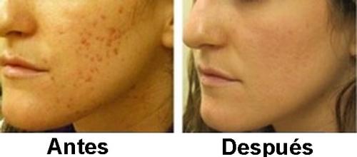 efectiva eliminación del acne El ms efecti - Imagen 3
